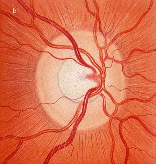 重庆医学界又出大新闻，谁说白内障青光眼不可逆……