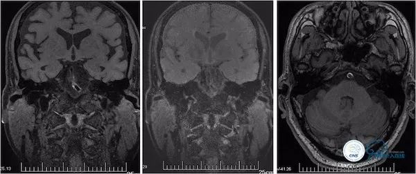 天坛医院脑血管狭窄手术做得好吗,天坛医院动脉狭窄介入手术费用