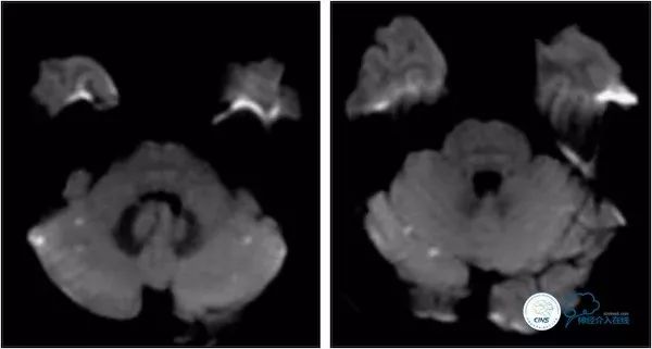 天坛医院脑血管狭窄手术做得好吗,天坛医院动脉狭窄介入手术费用
