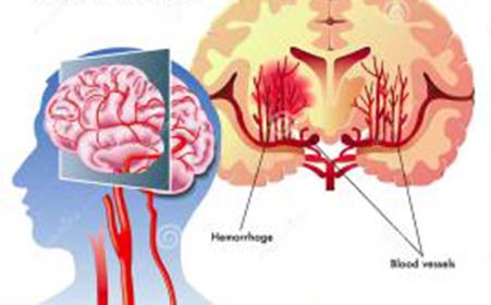 脑血栓是怎样形成的?与3种血管病变有关,用4招可预防
