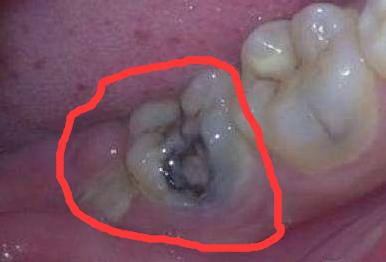 舒卿治疗牙疼牙龈肿痛,治疗牙龈肿痛的小方法