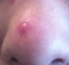 鼻子上挤出的白色条状物到底是啥,鼻子两边能挤出白色东西的是什么