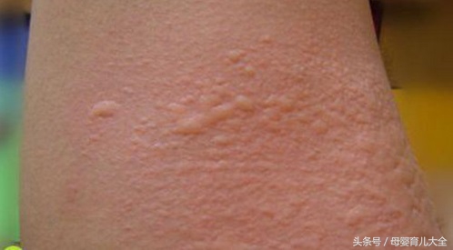 回了趟老家身上起疙瘩,小孩回农村老家身上长疙瘩非常痒