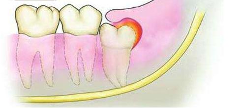 娌荤枟鐗欓緢鑲跨棝鐨勫皬鏂规硶,鐗欓緢鑲跨棝鎬庝箞鏀捐娌荤枟