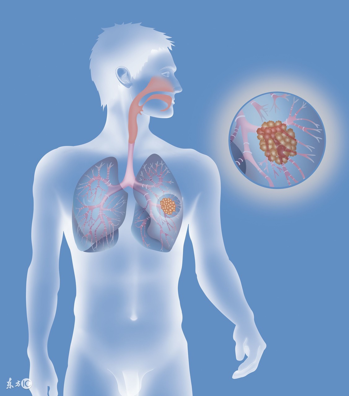气管插管麻醉是吸入麻醉吗,什么手术麻醉需要气管插管