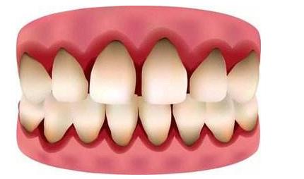 娌荤枟鐗欓緢鑲跨棝鐨勫皬鏂规硶,鐗欓緢鑲跨棝鎬庝箞鏀捐娌荤枟