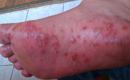 如何预防手足口病小常识,手足口病症状和预防方法