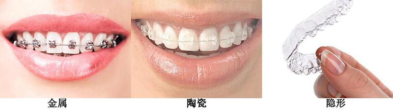 小儿牙齿矫正时间,牙齿矫正拔牙四颗收缝要多少时间