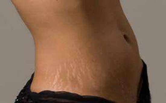 肥胖肚皮长花纹怎么办,肚子上有纹路胖子瘦下来能消除吗