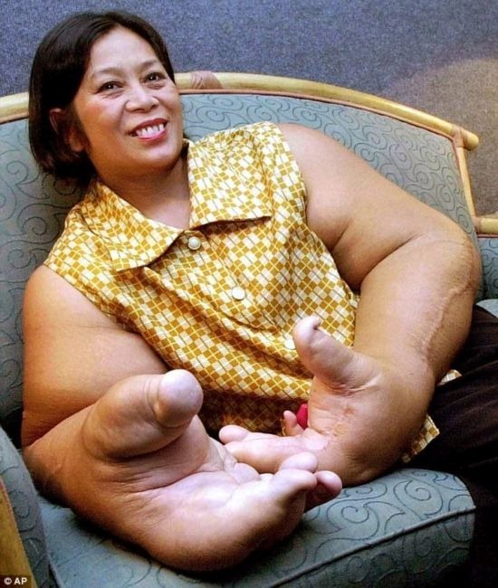 10个人体器官最大的世界纪录,巨大的人体器官