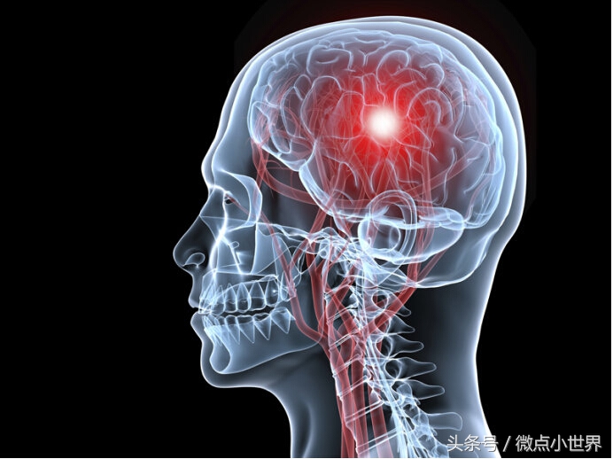 干细胞治疗中风偏瘫能彻底突破吗,中风干细胞技术