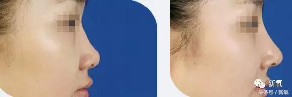 做了个达拉斯隆鼻，假体直接戳到脑门，我是不是和张檬、刘雨欣遇到了同一个医生！