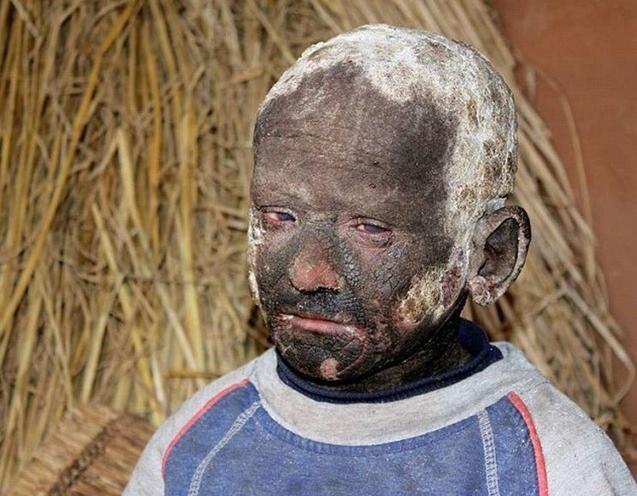 印度男孩身上长满了什么,印度11岁男孩长满鳞片