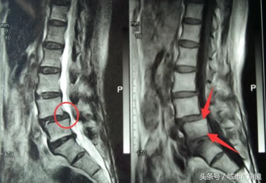 腰椎间盘突出脚底板麻木如何治疗,腰椎间盘突出腿麻木最快缓解针灸