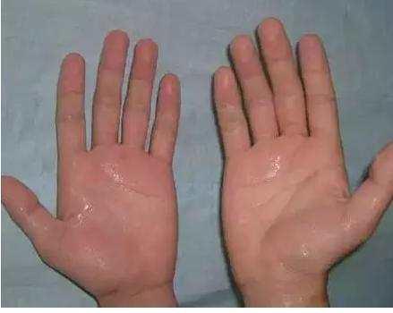 如何有效的抑制手掌出汗,手心容易出手汗怎么办