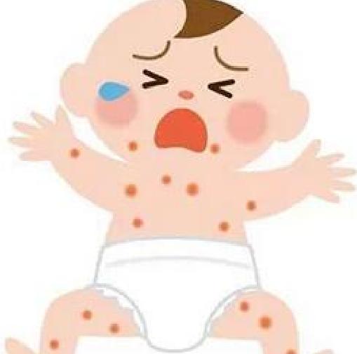 婴儿期一些常见病的治疗方法：湿疹