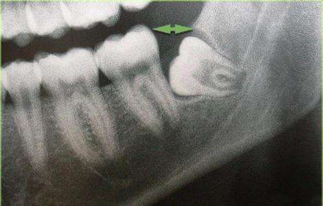 埋在肉里的智齿拔掉需要多少钱,智齿拔掉还是剪掉牙龈肉