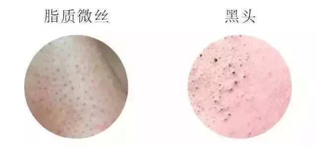 如何不挤就可以去黑头,黑头别再用手挤三个去黑头小妙招