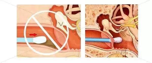 耳屎需要定期清理吗,耳屎是湿黄色粘稠如何清理