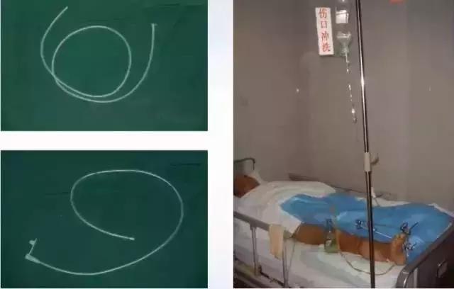 创面感染用什么抗生素,创面感染最佳治疗方案