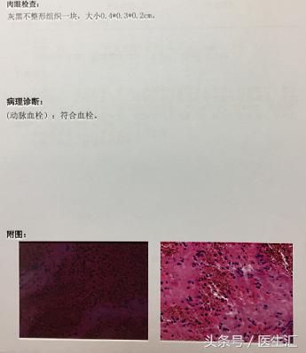 80岁老人突然脑梗塞,80岁老人脑梗塞怎么治
