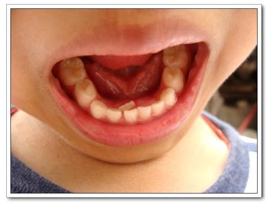 乳牙滞留拔除需要打麻药吗,乳牙滞留拔牙怎么矫正