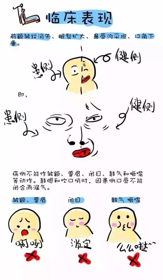 面瘫这个病是什么原因引起的,面瘫病是什么