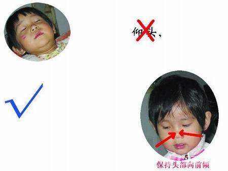 孩子鼻子痒一揉就流鼻血,8岁孩子流鼻血怎么回事