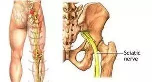 腰椎突出压迫坐骨神经痛怎么治疗,坐骨神经痛单侧屁股痛怎么治疗呢