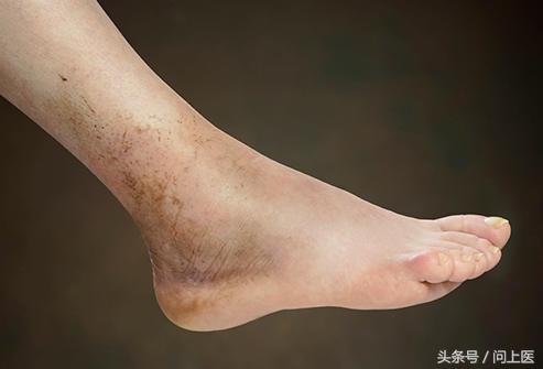 脚部肿胀走路就疼是啥原因,脚肿伴有麻木是什么病的前兆