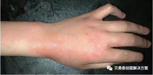 烧伤的诊断标准图表,烧伤病人典型症状