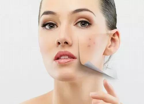 痘印跟身体哪些问题有关,痘印问题该不该去医院