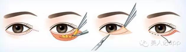 分不清是哪种黑眼圈,分不清楚是眼袋还是黑眼圈