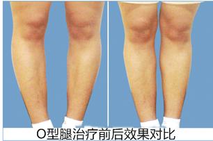 老年o型腿怎么矫正最快方法,o型腿矫正神器是否真的有用