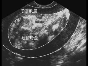 产后胎盘残留脱落出来是啥色,产后胎盘残留hcg值多少正常