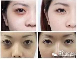 分不清是哪种黑眼圈,分不清楚是眼袋还是黑眼圈