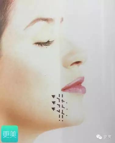 埋线美容线和不吸收线有什么区别,医院埋线和美容院埋线有什么差别