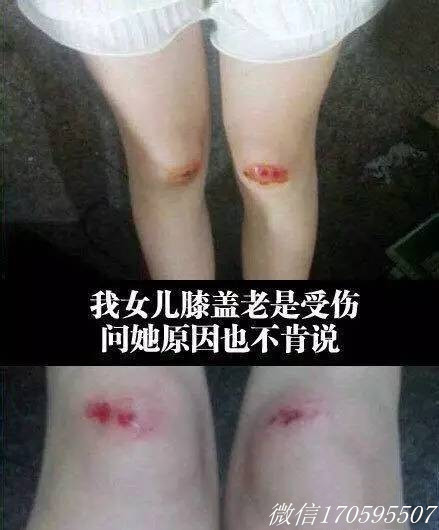 祛疤妙招—日本处方祛疤膏