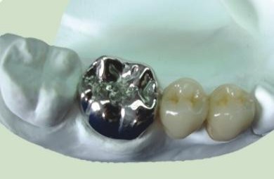 义齿怎么辨别真假,学会三招让你远离伪劣义齿