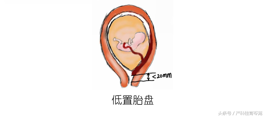 胎盘低就是前置胎盘吗,胎盘位置低在前壁