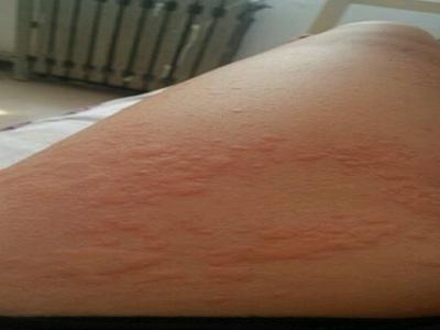 3岁宝宝反复发作过敏性*麻疹荨**,元凶竟然是它