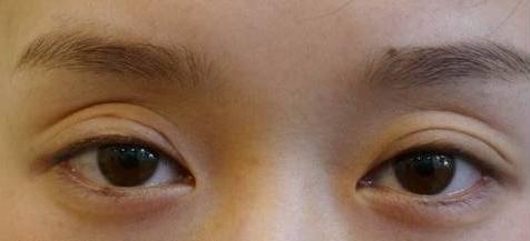 眼窝凹陷要怎么才能好看,眼睛一到下午上眼窝凹陷咋回事