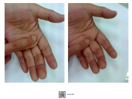 屈指狭窄性腱鞘炎最好的治疗方法,屈指肌腱腱鞘炎示意图