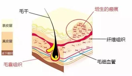 目前关于脱发的最新治疗方法,什么方法治疗脱发效果好