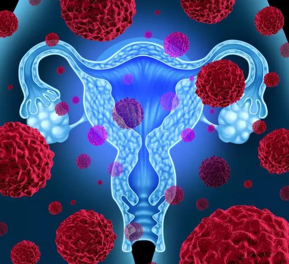 发病率最高的妇科癌症,中国卵巢癌发病率