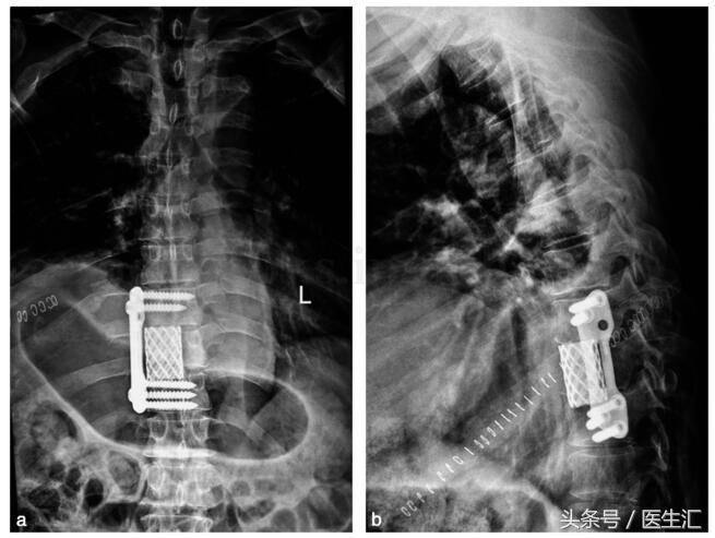 癌症脊柱骨转移怎么治疗,脊柱转移恶性肿瘤的最佳治疗方法
