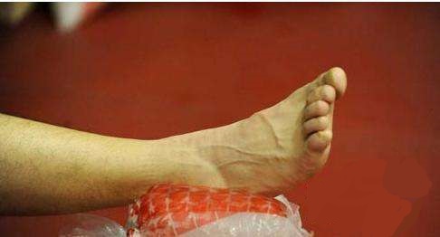 生活中崴脚紧急处理,突发情况崴到脚应该怎么处理