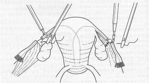 输卵管结扎复通术病历书写,输卵管结扎术后能不能做试管