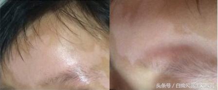 当你得了白癜风,白癜风抹药后起了水泡严重吗