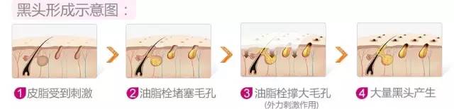 粉刺黑头去除最快方法,鼻子螨虫黑头怎么去除简单方法